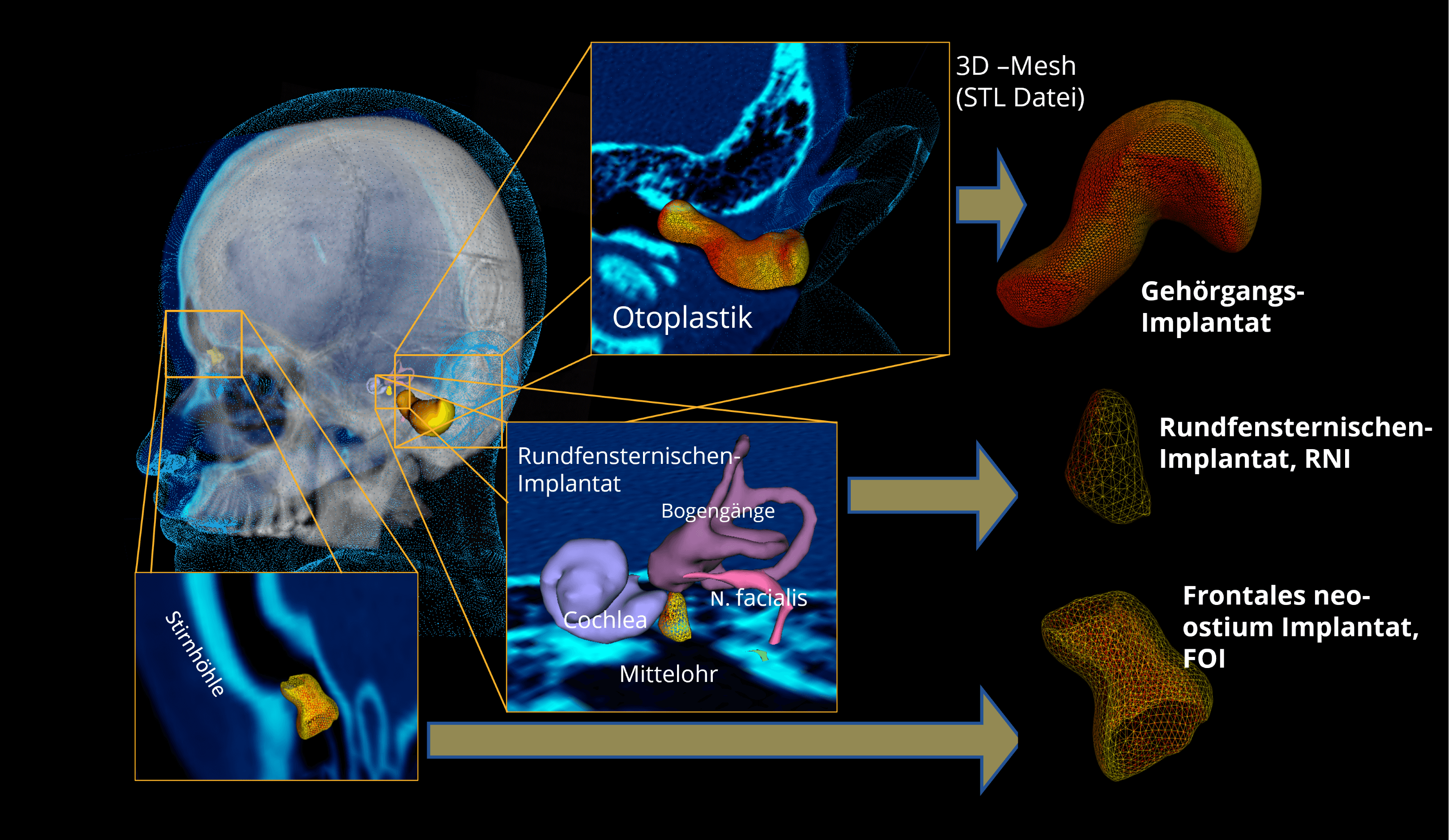 Grafik zu verschiedenen HNO Implantaten. Zu sehen ist ein Schädel mit drei 3D Mesh Darstellungen von Implantaten. Ein frontales neo-ostium Implantat (FOI) in der Stirnhöhle. Ein Rundfensternischenimplantat (RNI) im Mittelohr. Und ein Gehörgangsimplantat im Gehörgang.