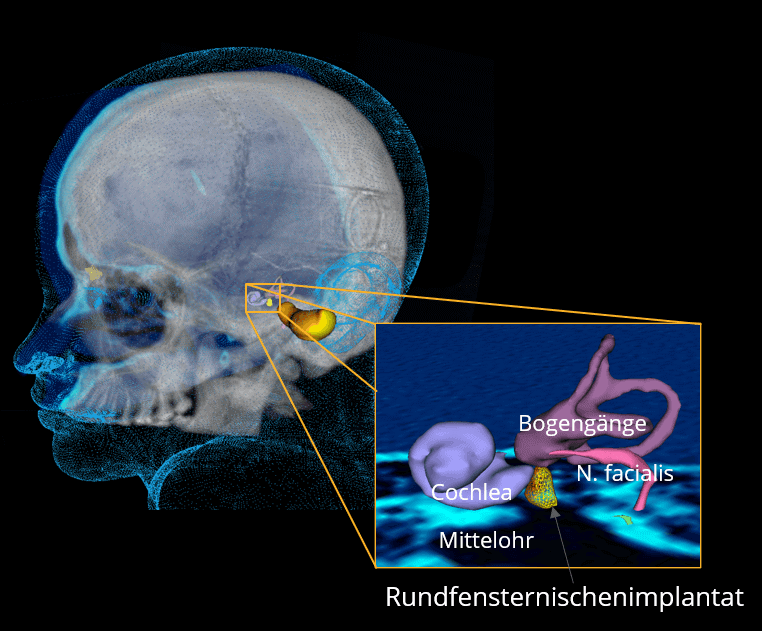 Grafik eines Schädels einer 3D Mesh Darstellungen von einem Rundfensternischenimplantats im Mittelohr. Umgeben ist das Implantat von der Cochlea, den Bogengängen und derm Nerv facialis.
